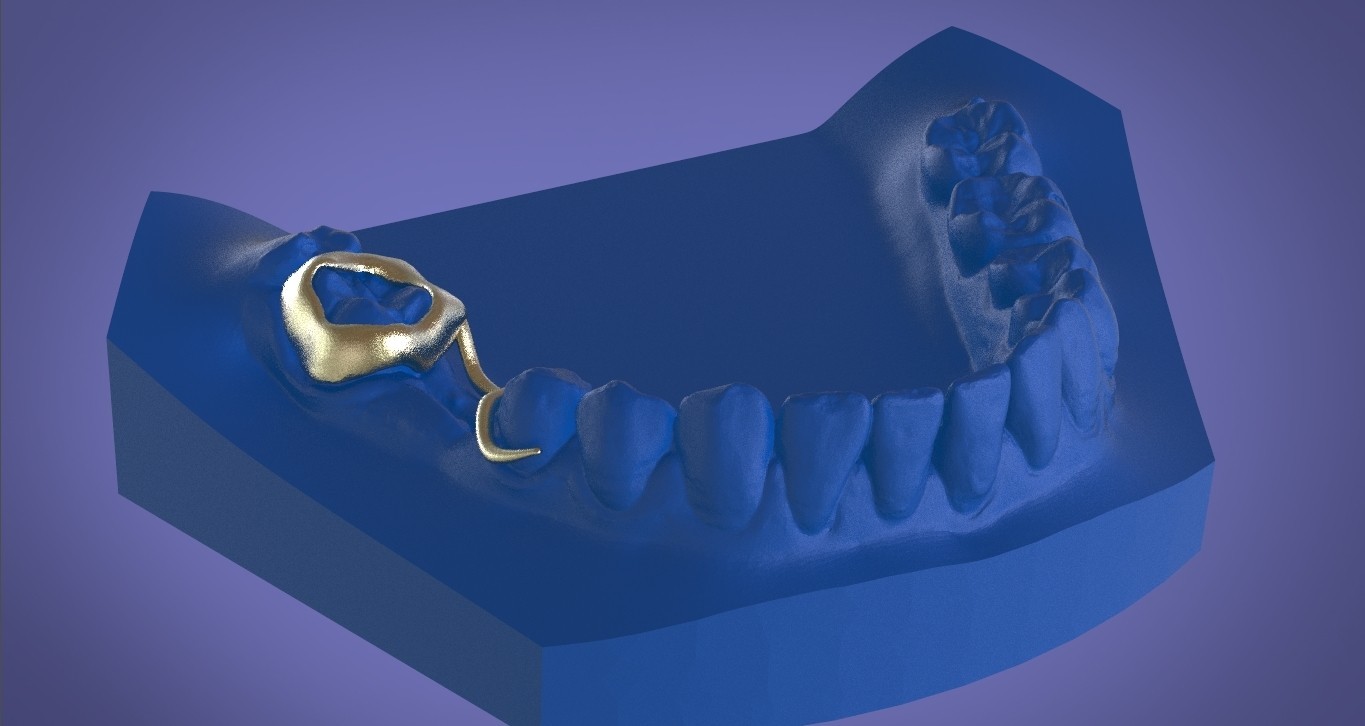 Download OBJ file Digital Space Maintainer • 3D print template ・ Cults