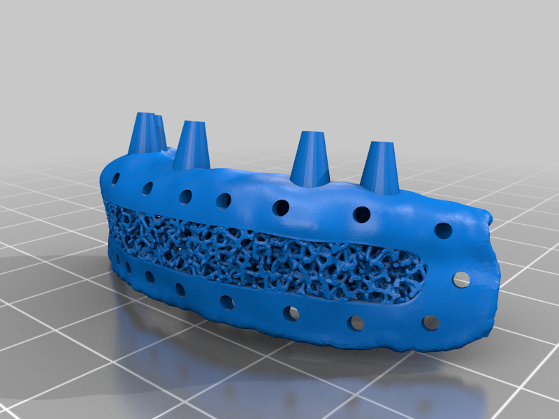 Free STL file IMPLANT 🦷・3D printing model to download・Cults